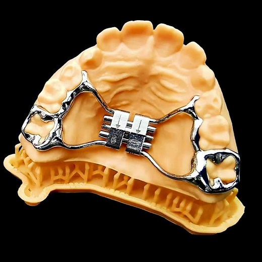 Hyrax Appliance | Orthodontics