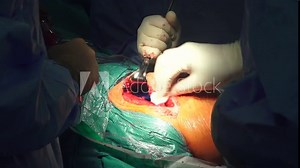 Hip replacement is a surgical procedure in which the hip joint is replaced by a prosthetic implant, that is, a hip prosthesis.