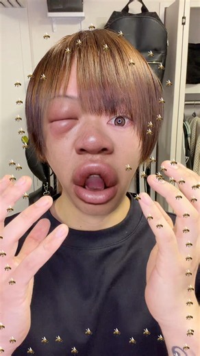 蜂に刺された際の対処法を教えてください🐝#shorts #蜂