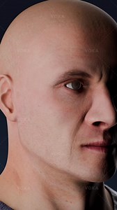 What is keratosis obturans and how does it impact the ear? Explore with VOKA in 3D Keratosis obturans is a rare but impactful condition involving accumulation of dense keratin masses in the external auditory canal, often accompanied by inflammation and epithelial disruption. Unlike simple earwax impaction, these sulfur-like plugs are tightly adhered and may cause pressure erosion of the surrounding bone over time. This condition often affects young adults and can be bilateral, though it may appe