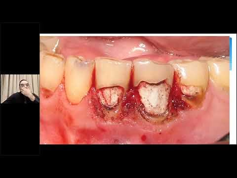 Step by step with Crown Lengthening