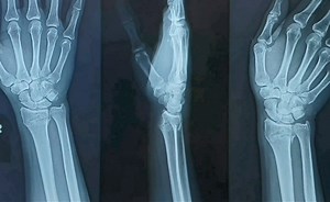 Distal Radius Fractures Treated With Percutaneous K- Wire Fixation