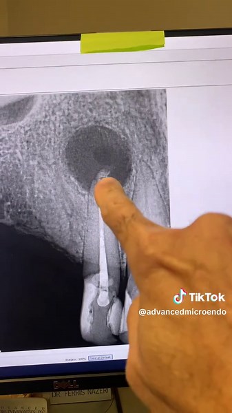 Understanding Dental Cysts: Insights from Experts