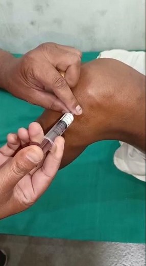 Intra-Articular injection. (How to inject knee joint)