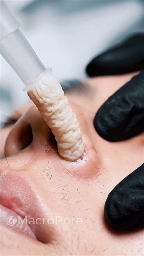 BLACKHEAD VACUUM — This Is Why It Loops 😬