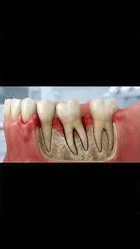 Why Teeth Fall Out?Gum Disease & Bone Loss Explained (3D Dental) #dentaleducation #3ddentalanimation