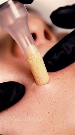 Clinical Vacuum Comedone Extraction | Dermatology ASMR #macroasmr #blackheadremoval