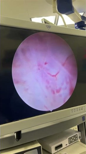 تقشير البروستات بالليزر د. امجد المسلماني من داخل غرفة العمليات