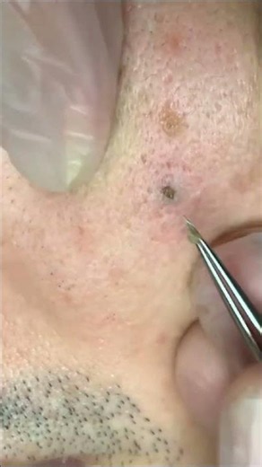 A perfect way to start day extracting this blackheads