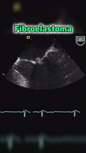 Fibroelastoma of Mitral valve #echocardiography #heart #2decho