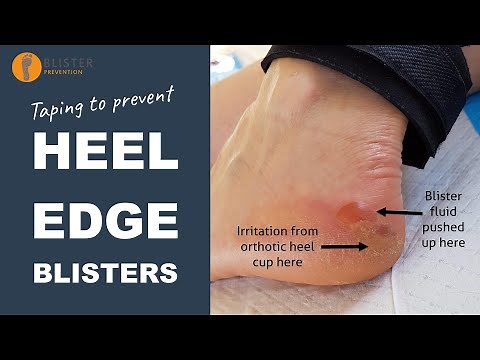 Taping To Prevent Heel Edge Blisters | Blister Prevention