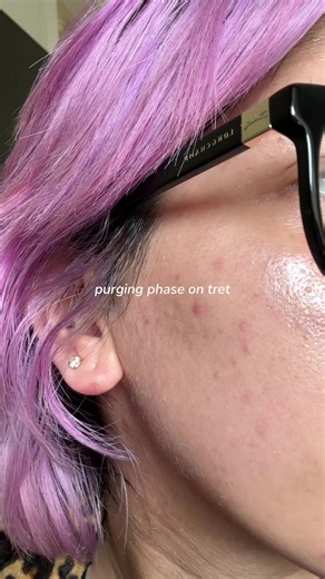 Understanding Dermaplaning and Tretinoin Purging