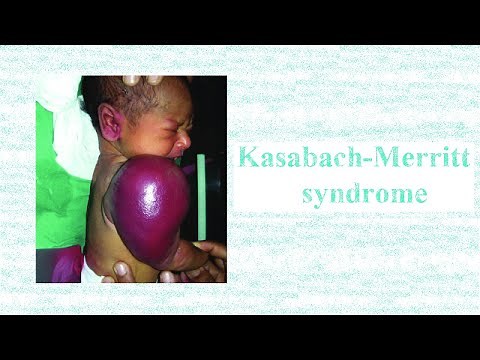 Kasabach-Merritt syndrome