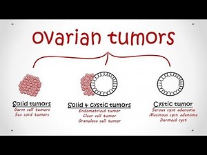 Ovarian Tumors (All types, Pathology)
