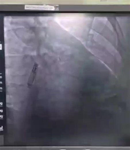 FIRST IN INDIA - WELCOMING WORLDS FIRST DUAL CHAMBER LEADLESS PACEMAKER AVEIR DR FROM ABBOTT CAPABLE OF DELIVERING DDDR PACING WITH TWO IMPLANTS IN RV AND RA APPENDAGE BASE - FIRST IMPLANT OF AVEIR… | Arun Gopi | 48 comments