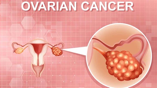 5 Signs of Ovarian Cancer You Should Watch Out For Early Detection