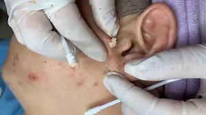 Vietnamese dermatologist removes giant pimple near patient's ear