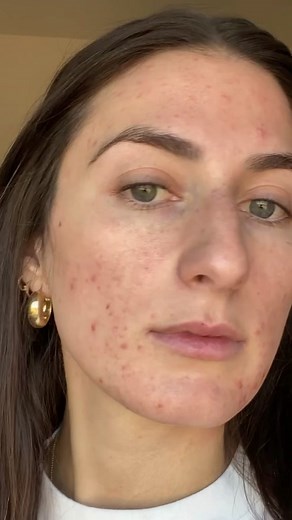 BBL Laser Treatment for Acne Journey to Clear Skin