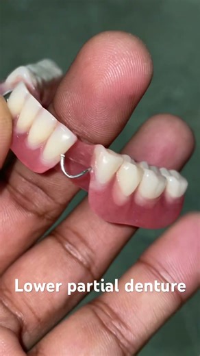 Lower partial denture 😬😬😬#apexdental #dentistry #partialdenture #orthodontist #splittooth
