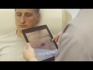 Mole removal - Consultation and procedure