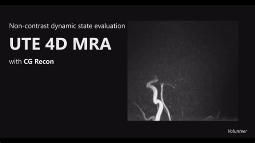 During follow-up #MRI examinations after vascular surgery such as coil embolization and stent placement, dynamic state evaluation can be extremely useful. However, sometimes artifacts from the turbulence and the metal devices placed at the lesion can prove an obstacle to accurate assessment. Our UTE sequence can achieve imaging in ultra-short TE in under100μsec., diminishing the interference from these kinds of artifacts. With our MR systems utilizing CG Recon, high quality non-contrast 4D MRA i