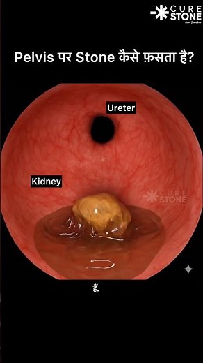Kidney Stone Stuck at PUJ 🔥 Pelvis-to-PUJ Animation Explained