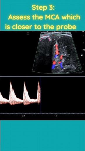HOW to perform Doppler Ultrasound of Middle Cerebral Artery (MCA).