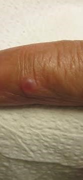 Ganglion Cyst Drainage by Dr. H.L. Greenberg at Las Vegas Dermatology