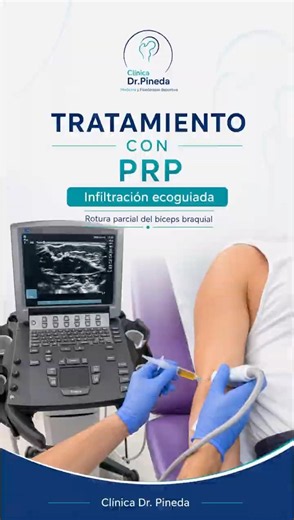 Tratamiento con PRP en rotura parcial del bíceps braquial | Infiltración ecoguiada