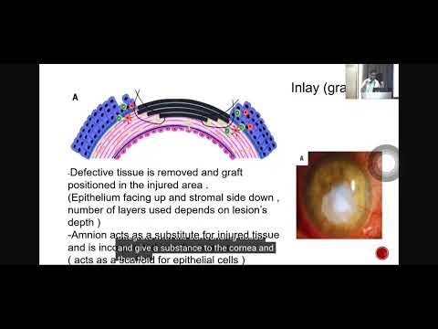 Amniotic Membrane Transplant for Refractory Corneal Ulcers