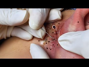 Clinical Spa Session | Blackhead Extraction & Acne Care for Skin Renewal