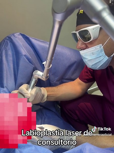 Algunas pacientes son candidatas a cirugia de labios en el consultorio , cuando no son muy grandes o es algo minimo que hay que corregir #labioplastia #labiosmenores #labiaplasty #laser #cirugiaintima #drherrera #tijuana