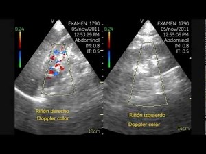 Left Renal Infarction - Pocket Ultrasound Bedside • Video • MEDtube.net