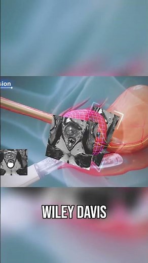 Prostate Cancer: My Tulsa Pro Treatment Journey & Doctor's Warning!