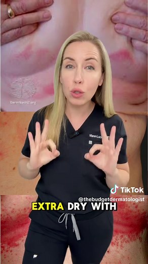 How to Treat Intertrigo: Effective Drugstore Remedies