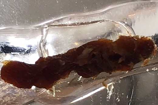 Watch this monster chunk of earwax being removed