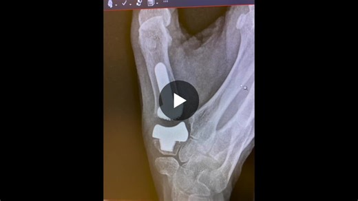 #worldfirst #innovation #handsurgery #3dprinting #medicaltechnology #patientcare #teamwork | Joris Duerinckx, MD PhD | 22 comments