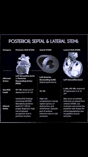 📌STEMI: Your Quick-Reference Guide for Every Cath Lab Scenario! 🚨 6 Critical STEMI Types 👉🏻 Must Know 🔹 Anterior | Inferior | Right Ventricular 🔹 Posterior | Septal | Lateral 💡✅ Artery Culprits: LAD = Anterior/Septal STEMI (⚠️ High risk of LV dysfunction, septal rupture). RCA = Inferior/RV STEMI (💧 Fluids > Nitrates). LCx = Posterior/Lateral STEMI (🔍 Always check for associated mitral regurgitation). ✅ ECG Life-Savers: V1–V4 → Anterior II, III, aVF → Inferior V7–V9 → Posterior V4R → Rig