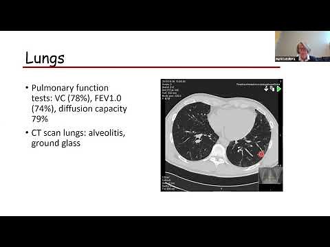 Inflammatory myopathies- an evolving spectrum of disease