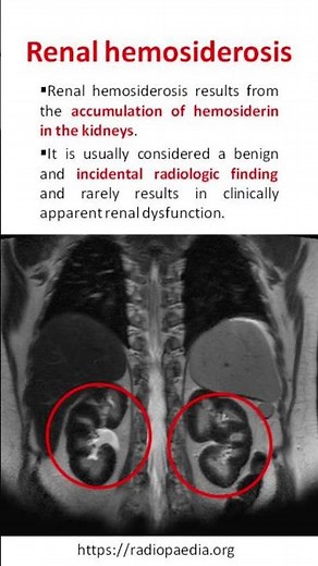 Renal hemosiderosis
