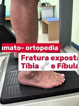 Exposed fracture of tibia and fibula / Traumato-orthopedic physiotherapy