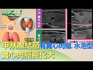 甲狀腺結節有實心肉瘤.水泡型 實心肉瘤癌化大 健康2.0