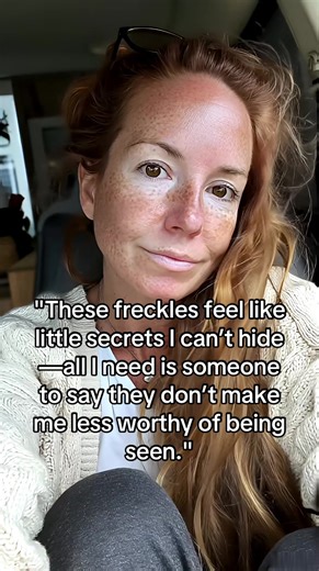 Embracing Freckles: Celebrating Unique Beauty