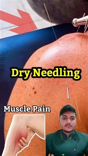 dry needling #dryneedling #dryneedlingtherapy #musclepain