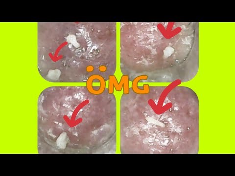 Nose Blackheads & Pimples Removal Compilation:Massive Pus Pimples Extraction So Addictive to Watch!