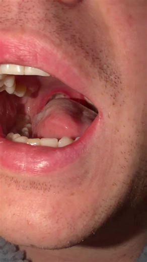 Post-Op Day 7: Tonsillectomy Recovery Update