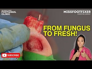 Satisfying Fungal Toenail Removal by MissFootFixer