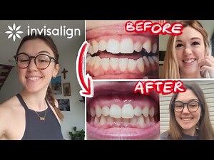 MY 10 MONTH INVISALIGN JOURNEY || smile transformation