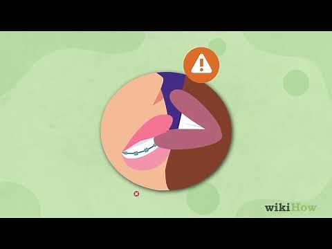 How to Make Out With Braces