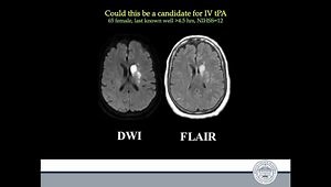 Acute Stroke tPA and TNK